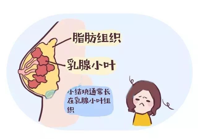 是正常乳腺小叶生理性增生与复旧不全,乳腺正常结构出现紊乱,怀孕期间