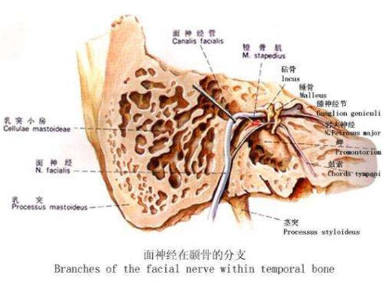 贝尔面神经麻痹重症早期行神经减压术利于恢复