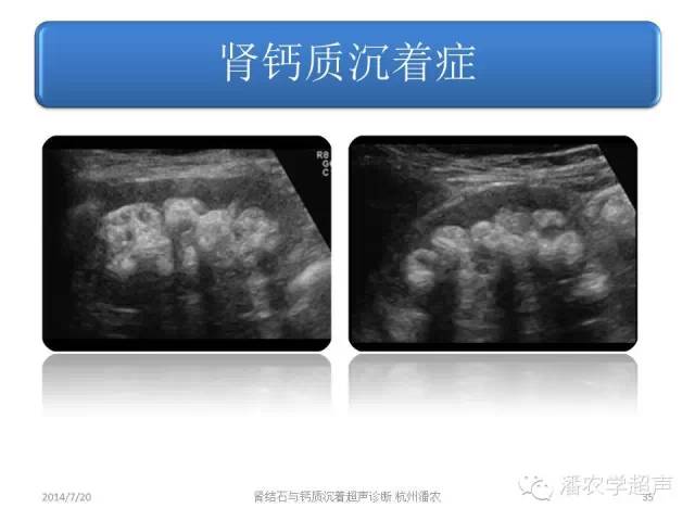 超声微课堂肾结石和肾钙质沉着症超声表现的异同之二