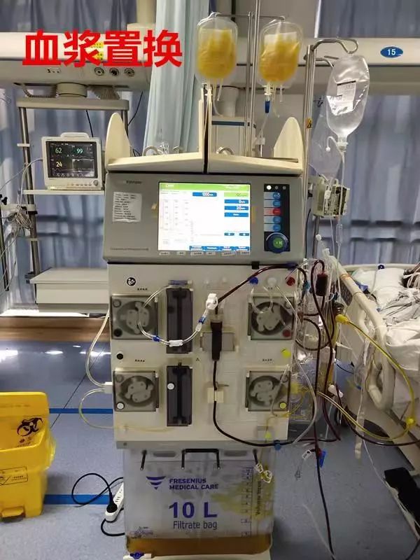 医院动态丨我院icu开展首例血浆置换术 为患者带来"新生曙光"
