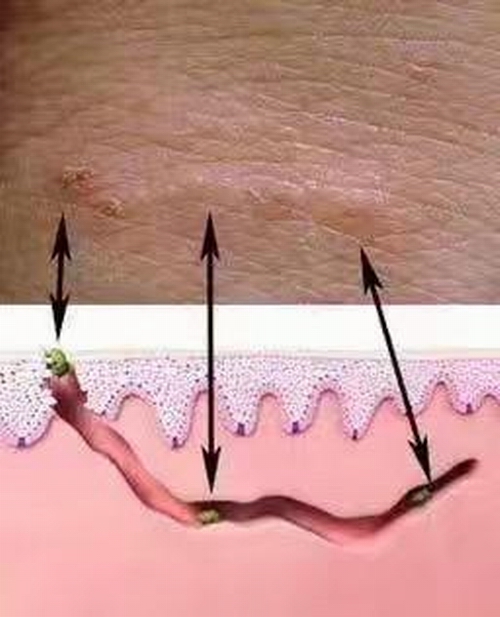 疥疮的病因与鉴别_疥虫