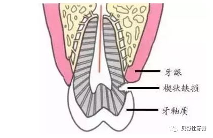 牙齿楔形缺损怎么办