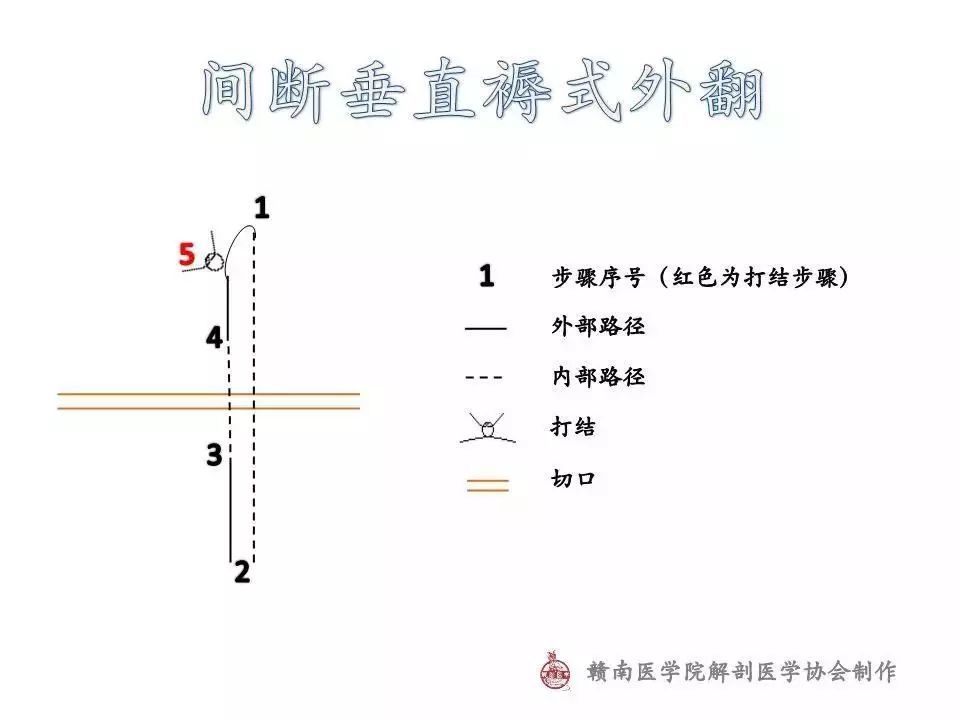 间断平行褥式内翻4.间断垂直褥式内翻3.连续锁边缝合2.单纯连续缝合1.