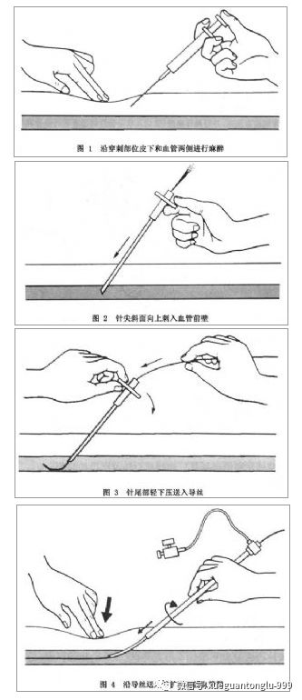 怎样避开深静脉穿刺置管术中的那些坑?史上最详细的总结来了