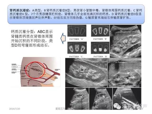 【超声微课堂】肾结石和肾钙质沉着症超声表现的异同之二