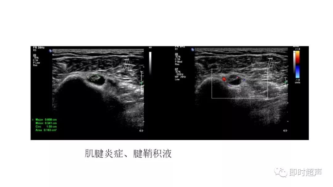 超声的主要表现:肌腱肿胀,回声减低;腱鞘增厚 腱鞘积液,血流信号增加