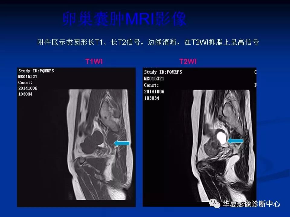 女性盆腔解剖及常见病变的mri诊断