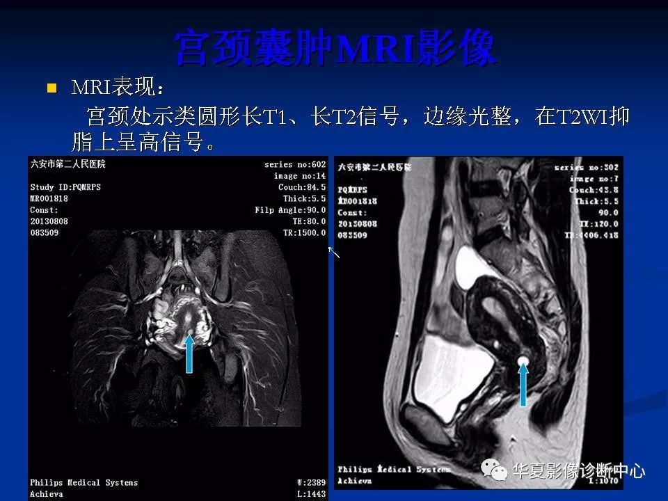 女性盆腔解剖及常见病变的mri诊断