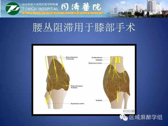 腰丛神经阻滞的临床应用