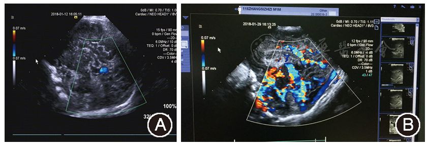 临床研究与实践新生儿脑静脉窦血栓五例诊断和治疗