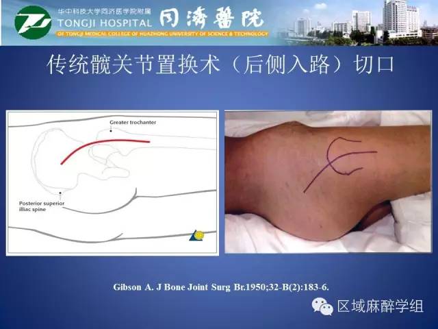 腰丛神经阻滞的临床应用