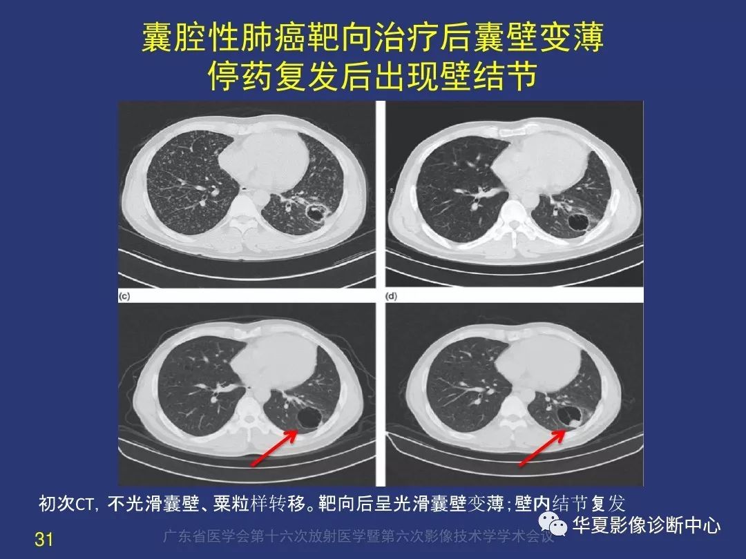 囊腔样肺癌的影像特征和鉴别诊断