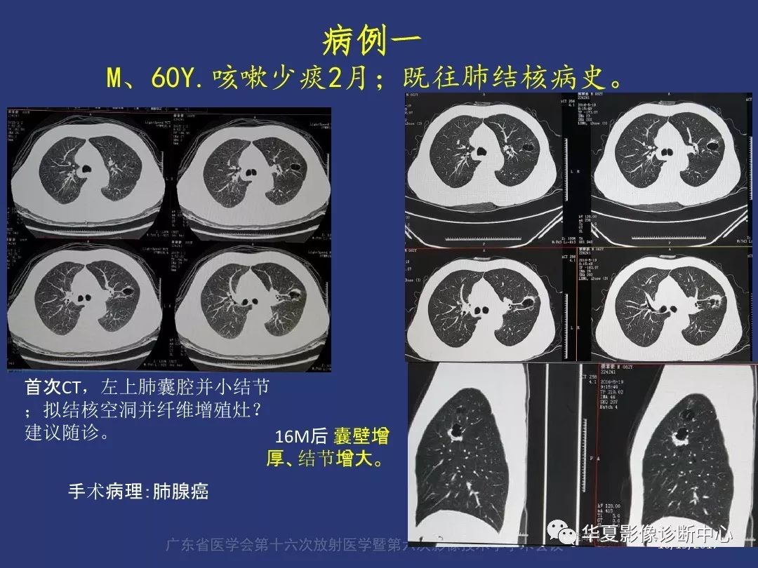 囊腔样肺癌的影像特征和鉴别诊断