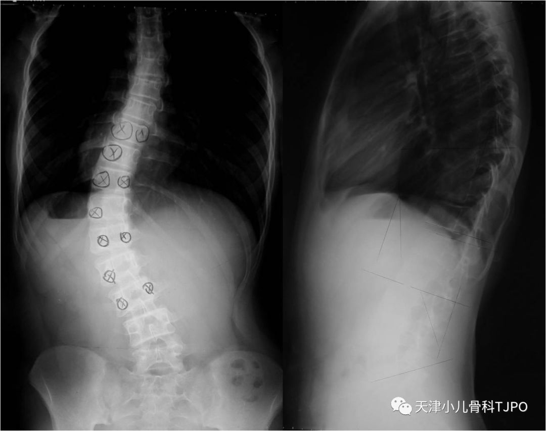 胸椎（T12）压缩性骨折治疗记录 - 知乎