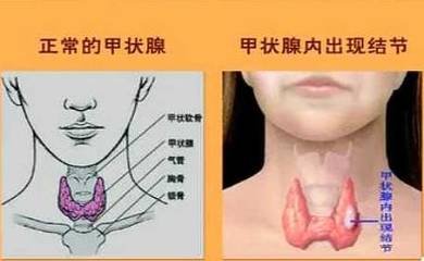 甲状腺结节需要注意的饮食看完的都转
