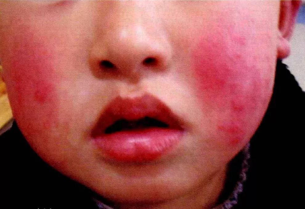 出疹期:初起表现为双侧面颊红色丘疹,迅速融合形成水肿性红斑,呈蝶形
