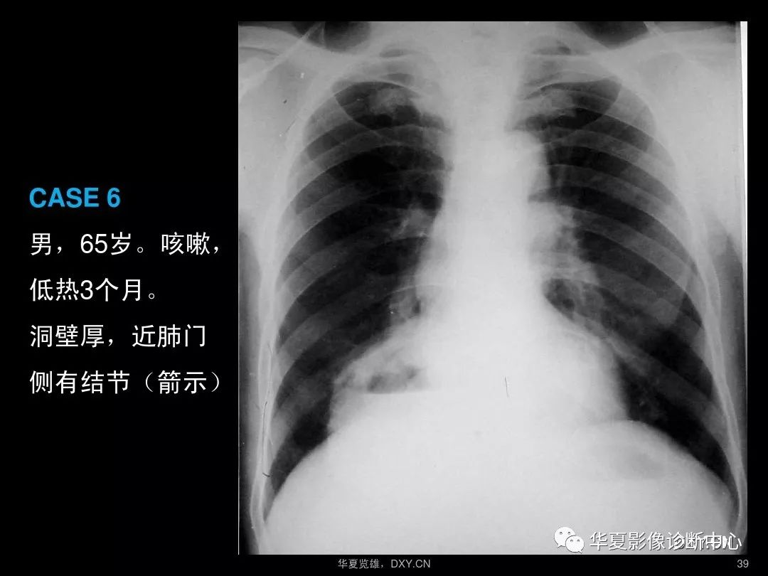 肺炎,肺结核,肺癌在ct及胸片上的区别