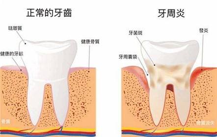 牙损怎么办