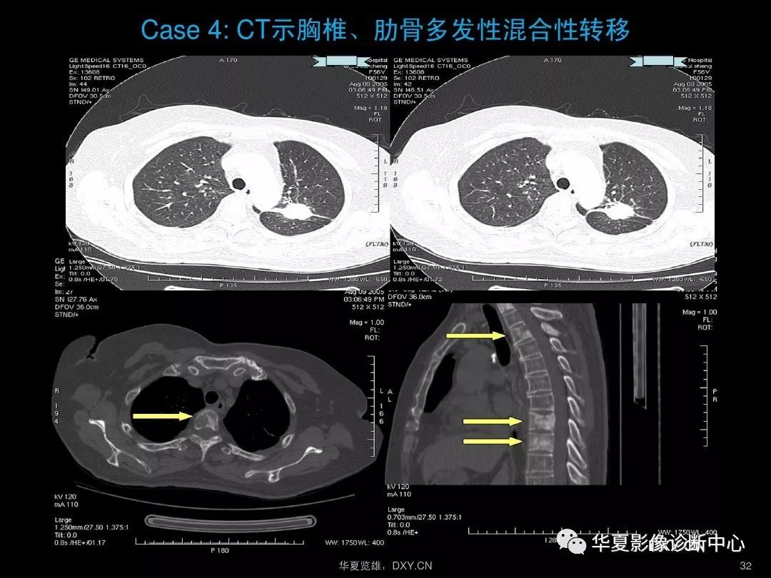 肺炎,肺结核,肺癌在ct及胸片上的区别