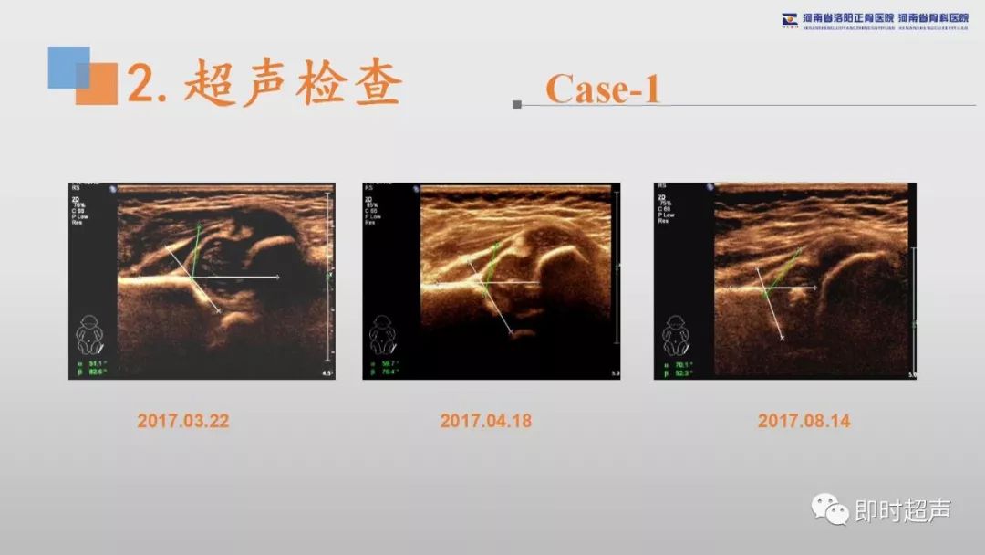 发育性髋关节发育不良(ddh)超声诊断基础