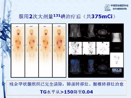 病例20期黄斌豪131碘全身扫描辅助诊断甲状腺癌多发骨转移一例