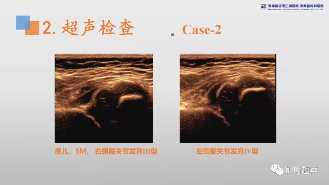 发育性髋关节发育不良(ddh)超声诊断基础