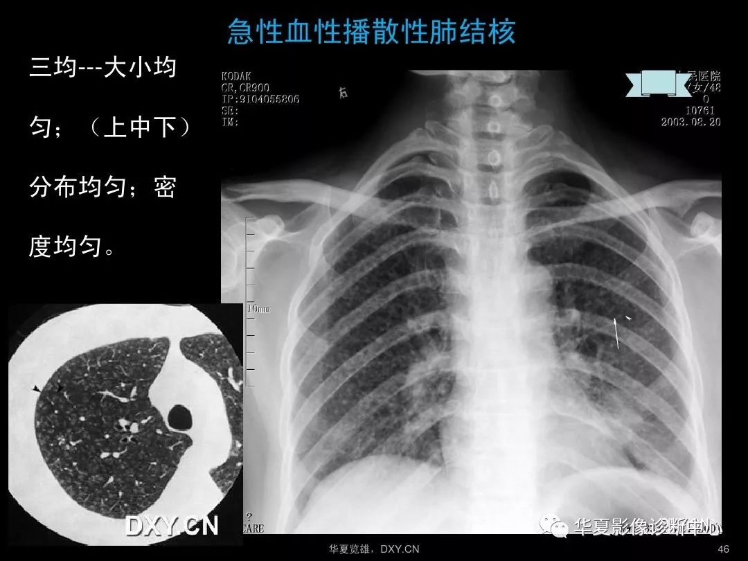 肺炎肺结核肺癌在ct及胸片上的区别