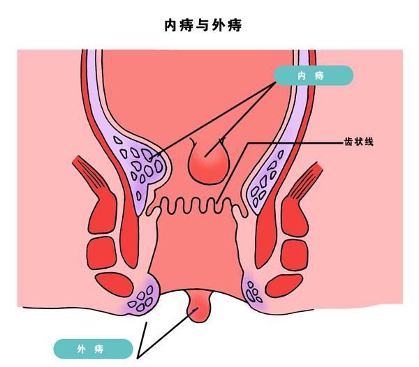 肛周疼痛,肛门直肠坠胀感,肛门肿物脱出 常见病症3 肛门分泌物 瘙痒