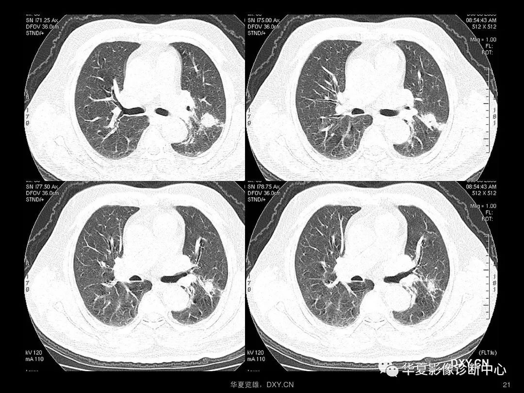 肺结核 ct正常 – 肺结核ct片图片图解 – Monacom