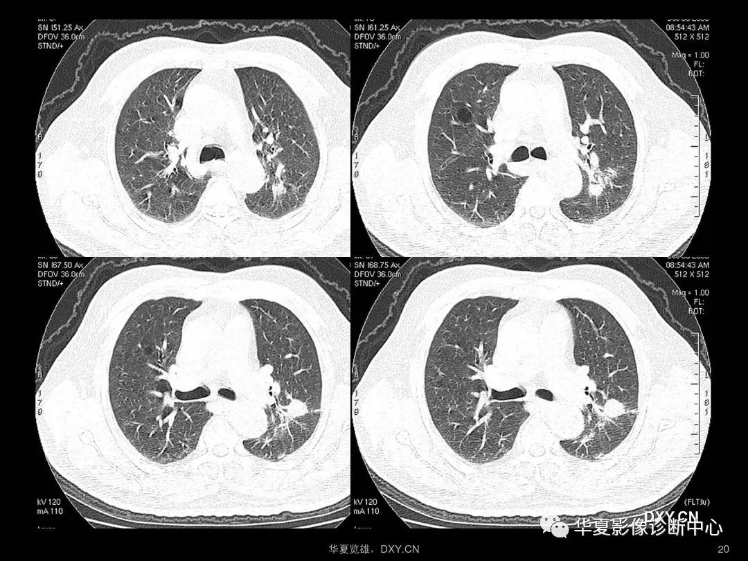 肺炎,肺结核,肺癌在ct及胸片上的区别