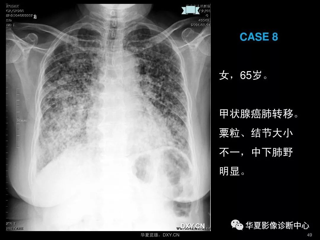 肺炎肺结核肺癌在ct及胸片上的区别