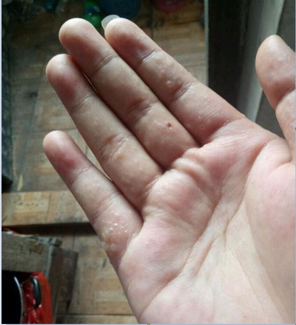 汗疱疹又称为出汗不良性湿疹,这是一种手掌,足跖部的水疱性疾病.