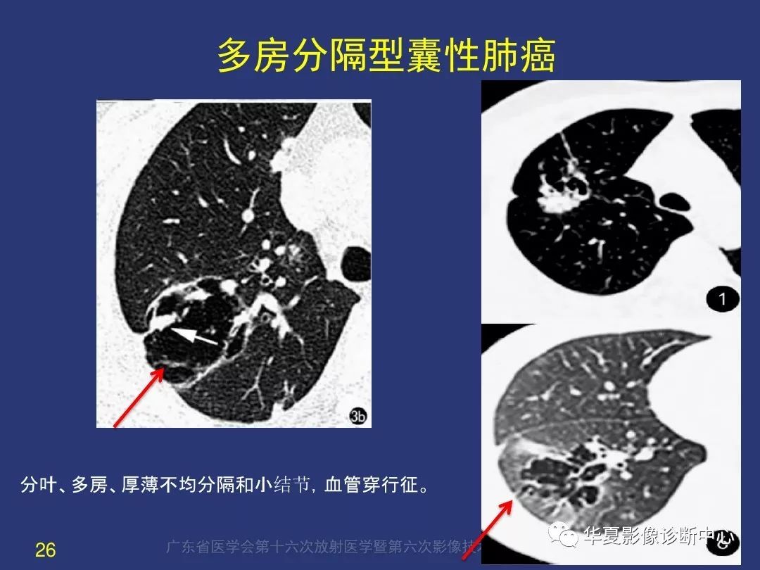 囊腔样肺癌的影像特征和鉴别诊断