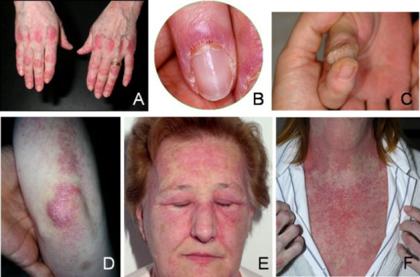 风湿病这些皮肤症状需警惕可能是合并肿瘤的信号