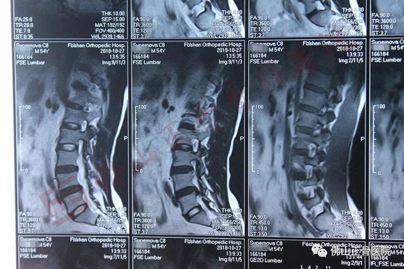 【真实案例】腰椎间盘突出11年,佛山正骨医院椎间盘镜