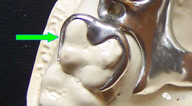 典型卡环组成: 卡环臂 卡环体 牙合支托 连接体 一,卡环臂