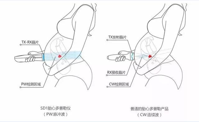 医用级别的家用胎心仪理邦sd1为宝宝的健康保驾护航