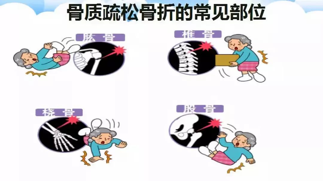 【科普】骨质疏松那些事儿!你知道怎么预防和治疗吗?_骨折