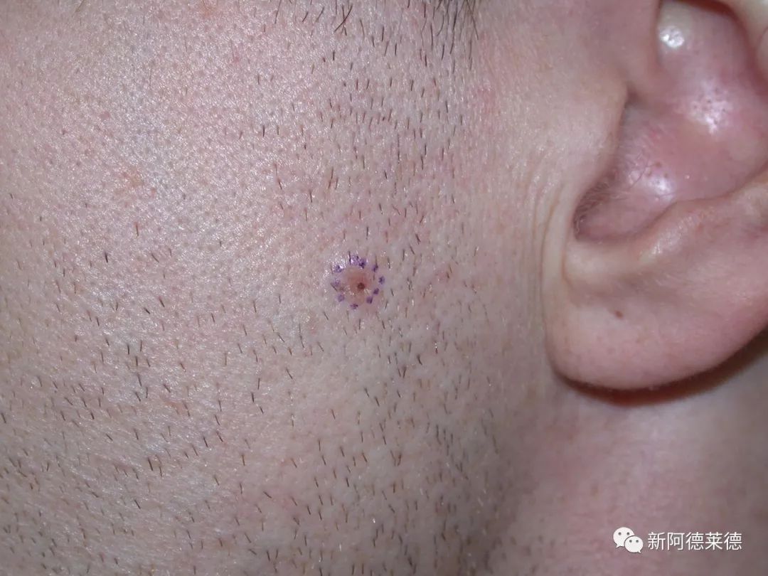 基底细胞癌(basal cell carcinoma,bcc)