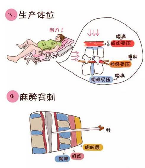 国家卫健委开始试点推广无痛分娩关于无痛分娩这些你要知道