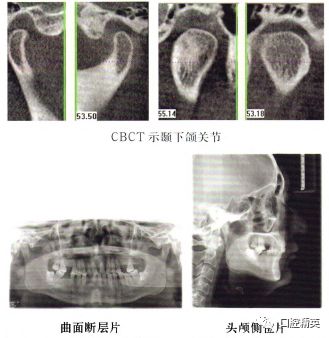 治疗前cbct示颞下颌关节曲面断层片及头颅侧位片