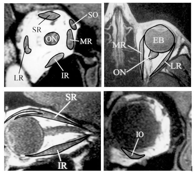 眼眶疾病定位——神经or肌肉?