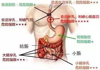 这是因为人的食道本身比较狭长,又存在一些生理性狭窄的部位,容易嵌顿