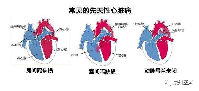 室间隔缺损是最常见的先天性心脏病之一,常常出现以下症状