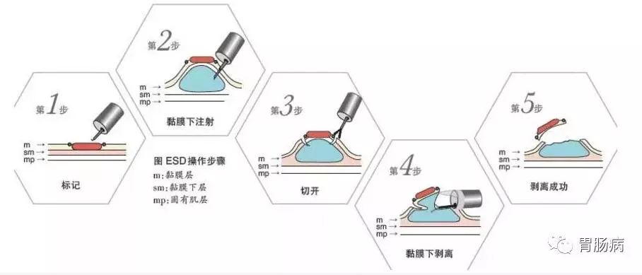 关于胃息肉,这是一篇最全面的科普