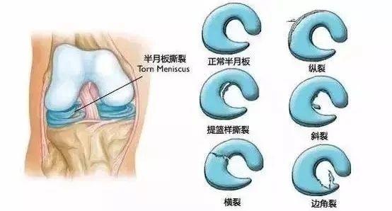 膝盖疼,膝盖肿,膝盖有弹响,很可能是你的半月板在报警