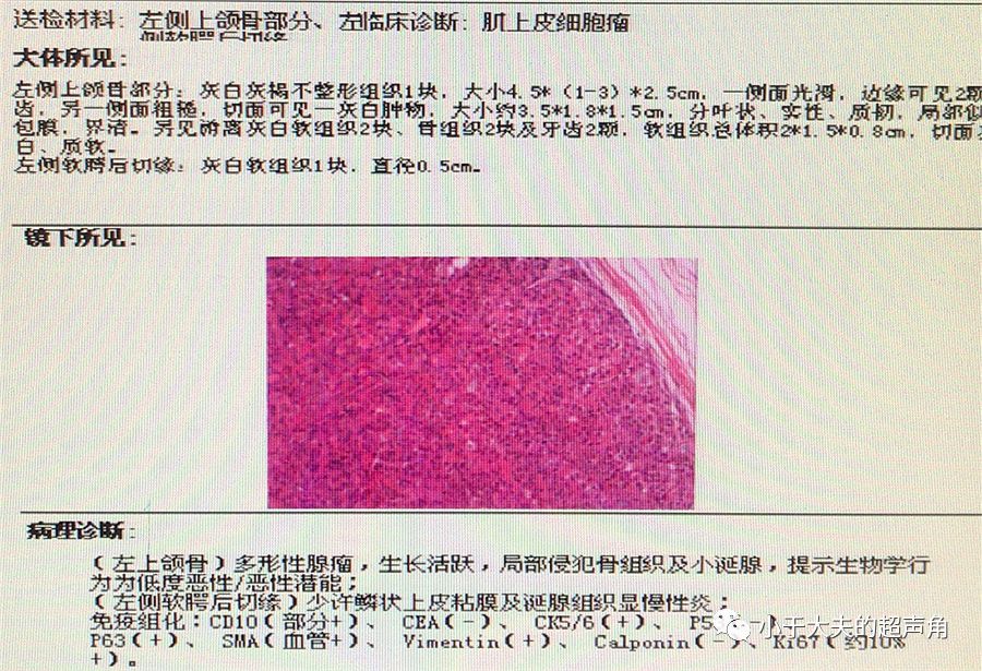 揭秘伤心的上颌骨迷途的多形性腺瘤