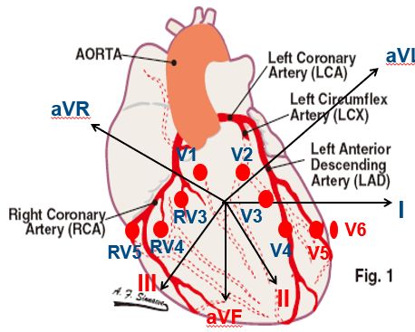 责任血管在左前降支,患者常伴有各种心律失常,心源性休克,心跳骤停