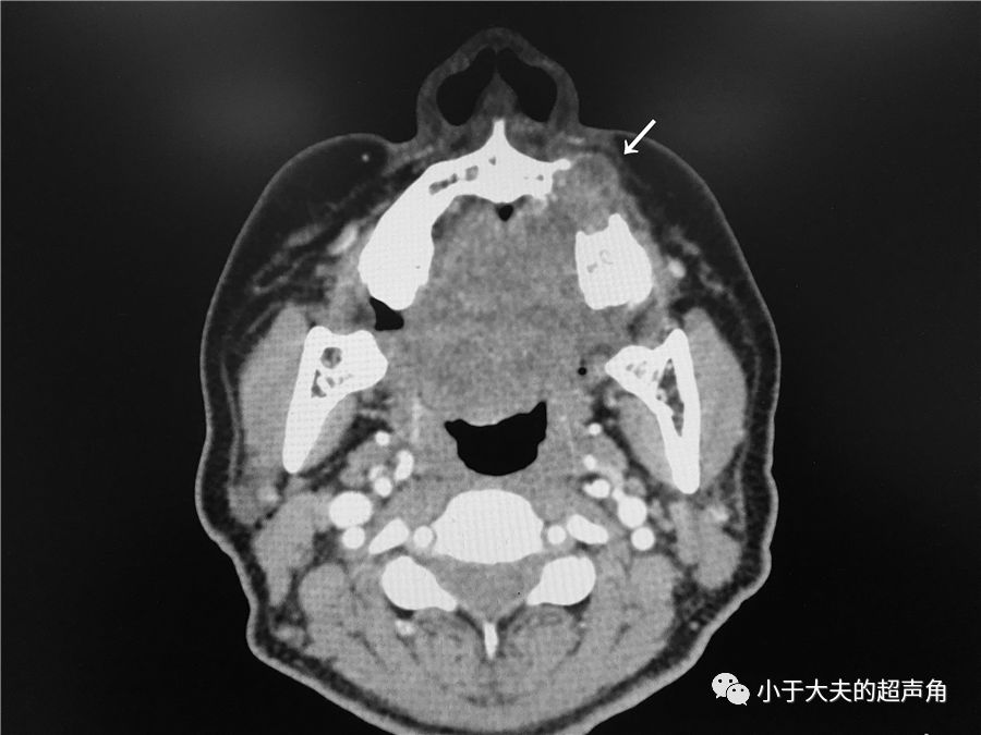 揭秘伤心的上颌骨迷途的多形性腺瘤