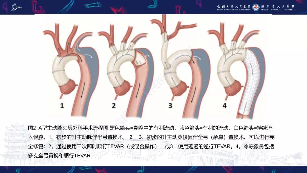 胸主动脉夹层修复术后疗效的影像评估